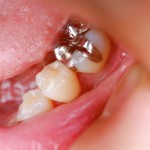 銀歯　ｾﾗﾐｯｸ　矯正　デメリット