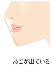 受け口のイラスト