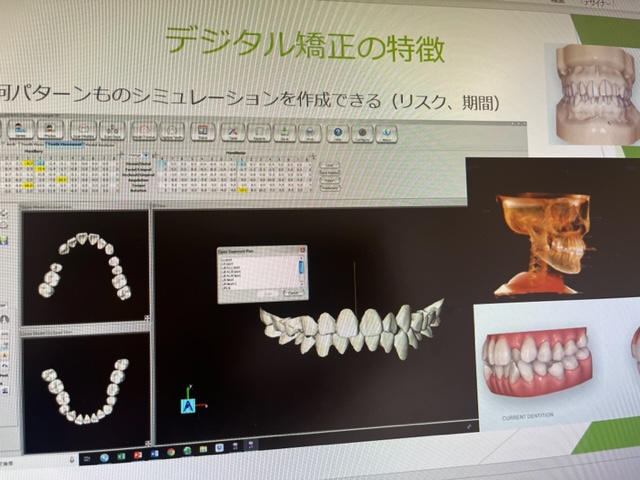 外科手術に抵抗がある方の選択肢　歯列矯正における3D分析
