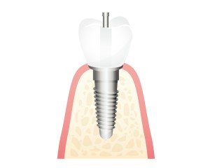 インプラント