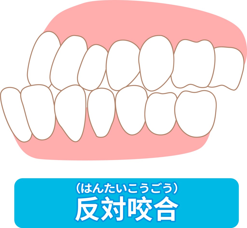 受け口、反対咬合とはどういう状態か しゃくれは矯正で治せるのか