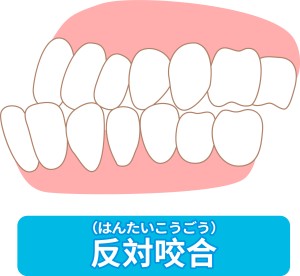 受け口　反対咬合　裏側矯正