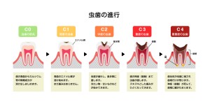 虫歯　治療段階