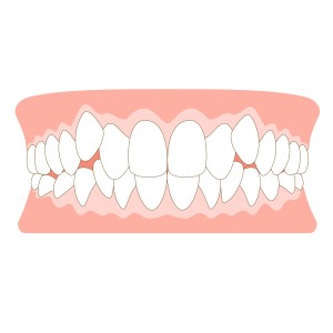 歯並び　骨格　関係性