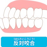 受け口（反対咬合）の治療法について　反対咬合は歯列矯正でなおるのか