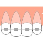 前歯だけの矯正は可能か 前歯だけ部分的に歯並び改善