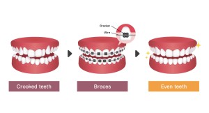 矯正治療　ブラケット　歯並び　噛み合わせ
