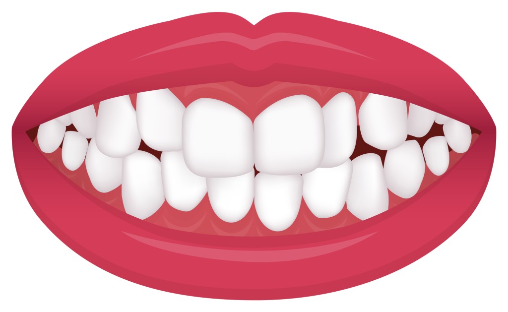 部分矯正に適している歯並び乱杭歯