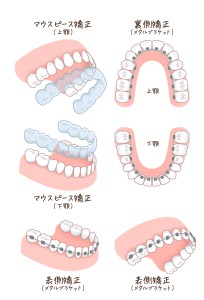 表側矯正　裏側矯正　マウスピース矯正