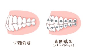 矯正　受け口