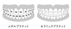 セラミック　メタル　ブラケット　矯正