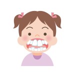 出っ歯　八重歯　上顎前突　特徴　矯正