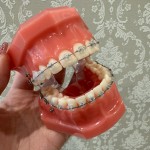 抜歯　裏側矯正　新宿歯科