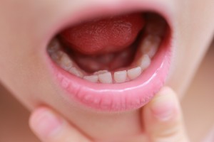 歯の逆転　原因