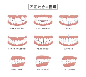 不正咬合　開咬　叢生　上顎前突　受け口