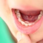 乳歯が残っていると歯並びにどう影響するか 子供の歯残っている場合の歯列