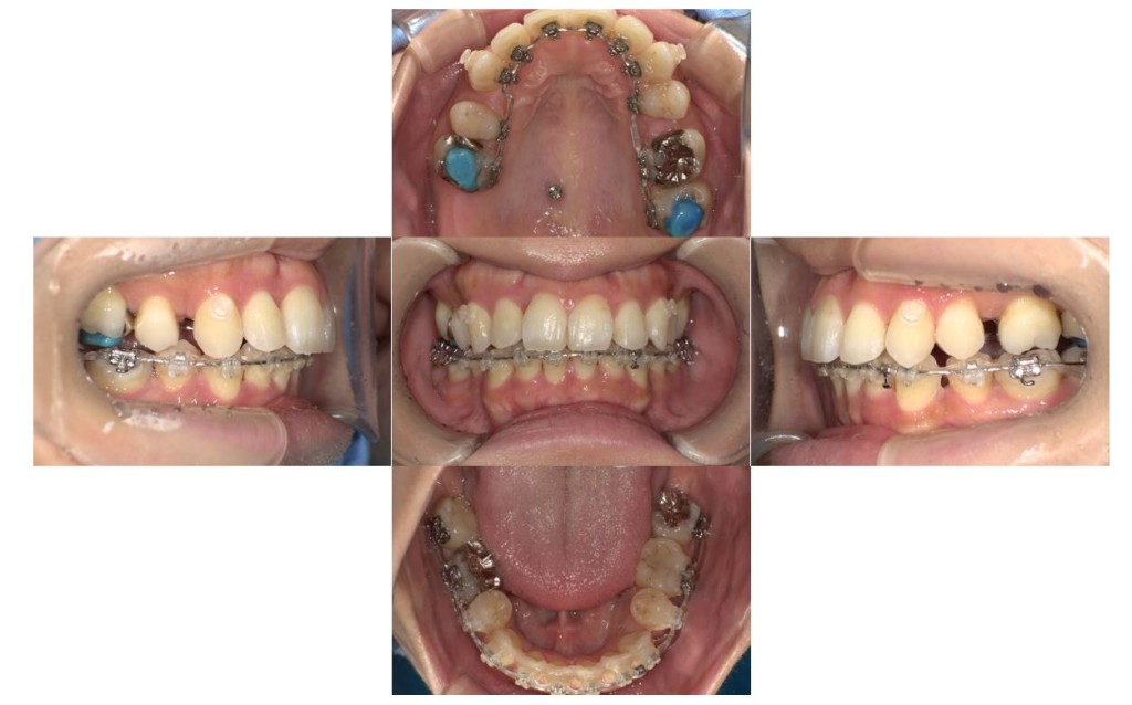 case35_overbite4