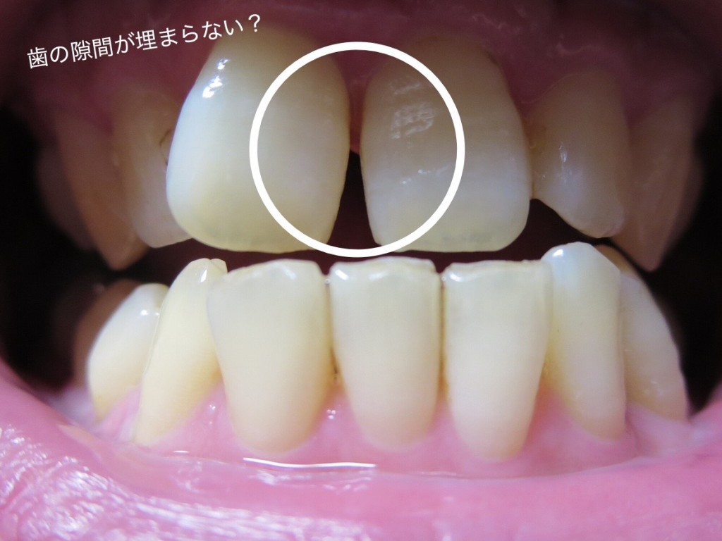 矯正後　歯の隙間　隙間が残ったまま矯正終了
