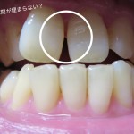 矯正後　歯の隙間　隙間が残ったまま矯正終了