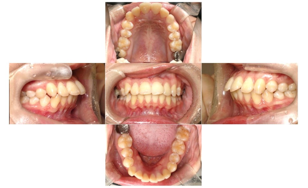 overbite1