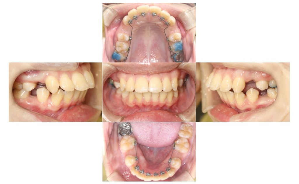 overbite2