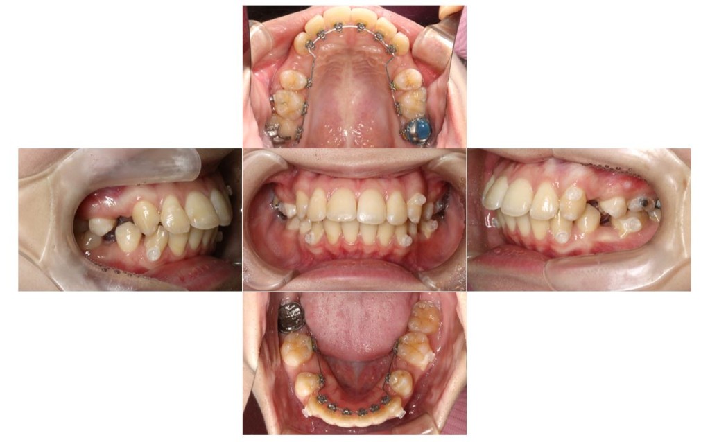 overbite3
