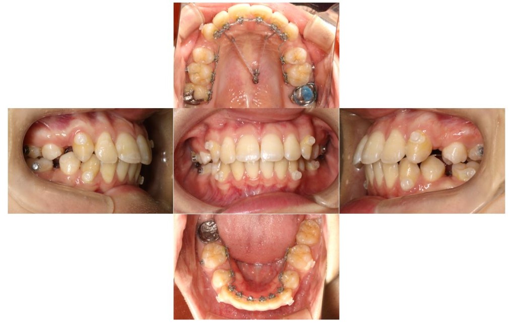 overbite4
