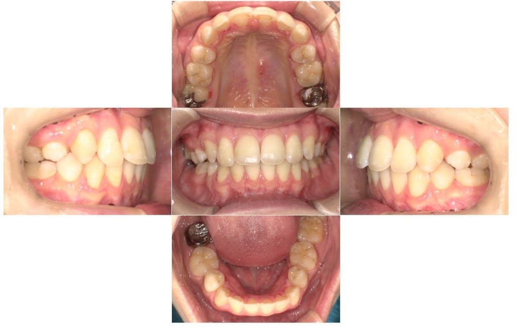 overbite5
