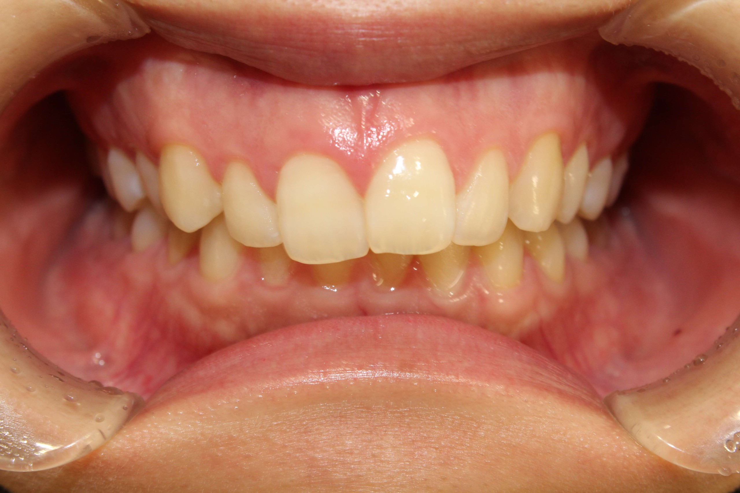 case50_deepbite Before