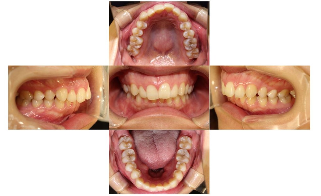 case50_deepbite1