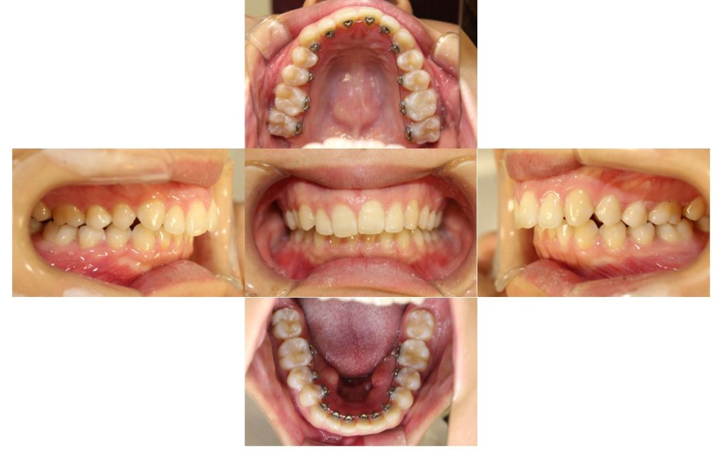 case50_deepbite2