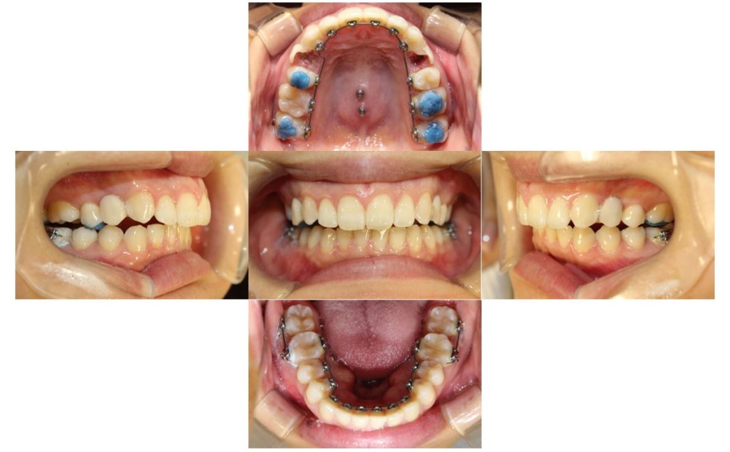 case50_deepbite3
