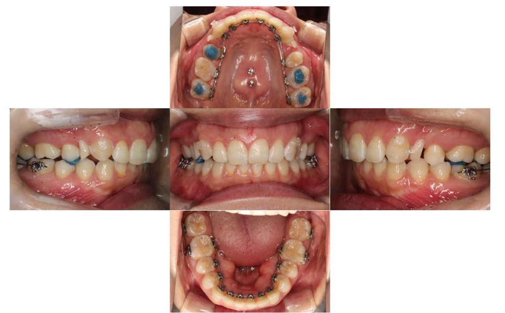case50_deepbite4