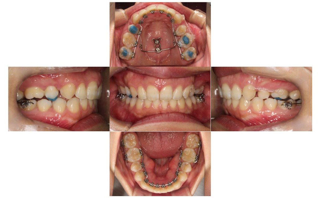 case50_deepbite5