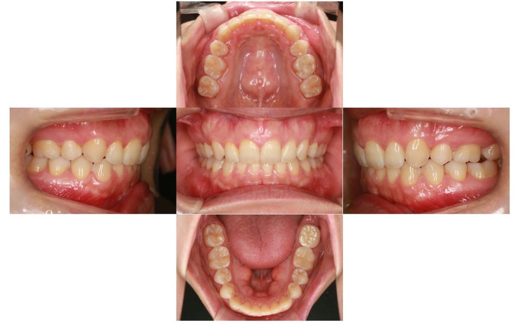 case50_deepbite6