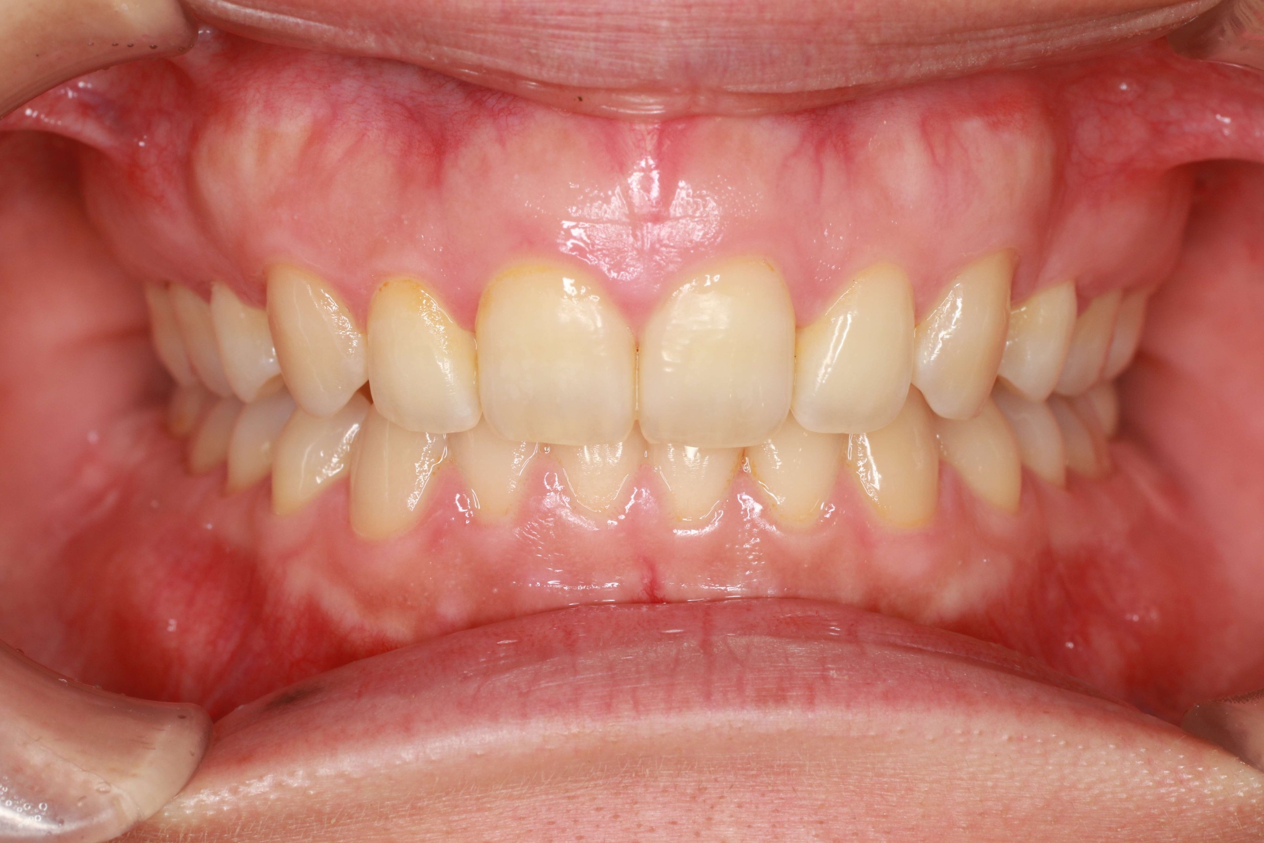 case50_deepbite After