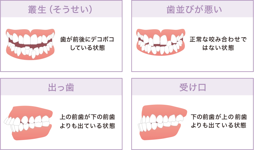 マウスピース型矯正に向いていない主な症状