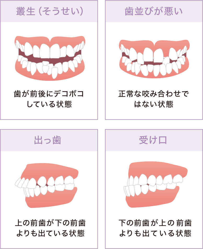 マウスピース型矯正に向いていない主な症状
