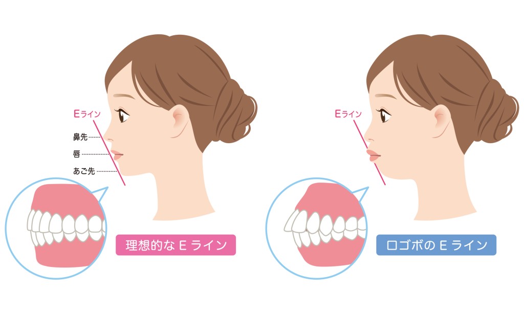 口ゴボかどうかセルフチェック　綺麗なEラインと口ゴボのEラインの違い　口ゴボの歯列矯正の効果