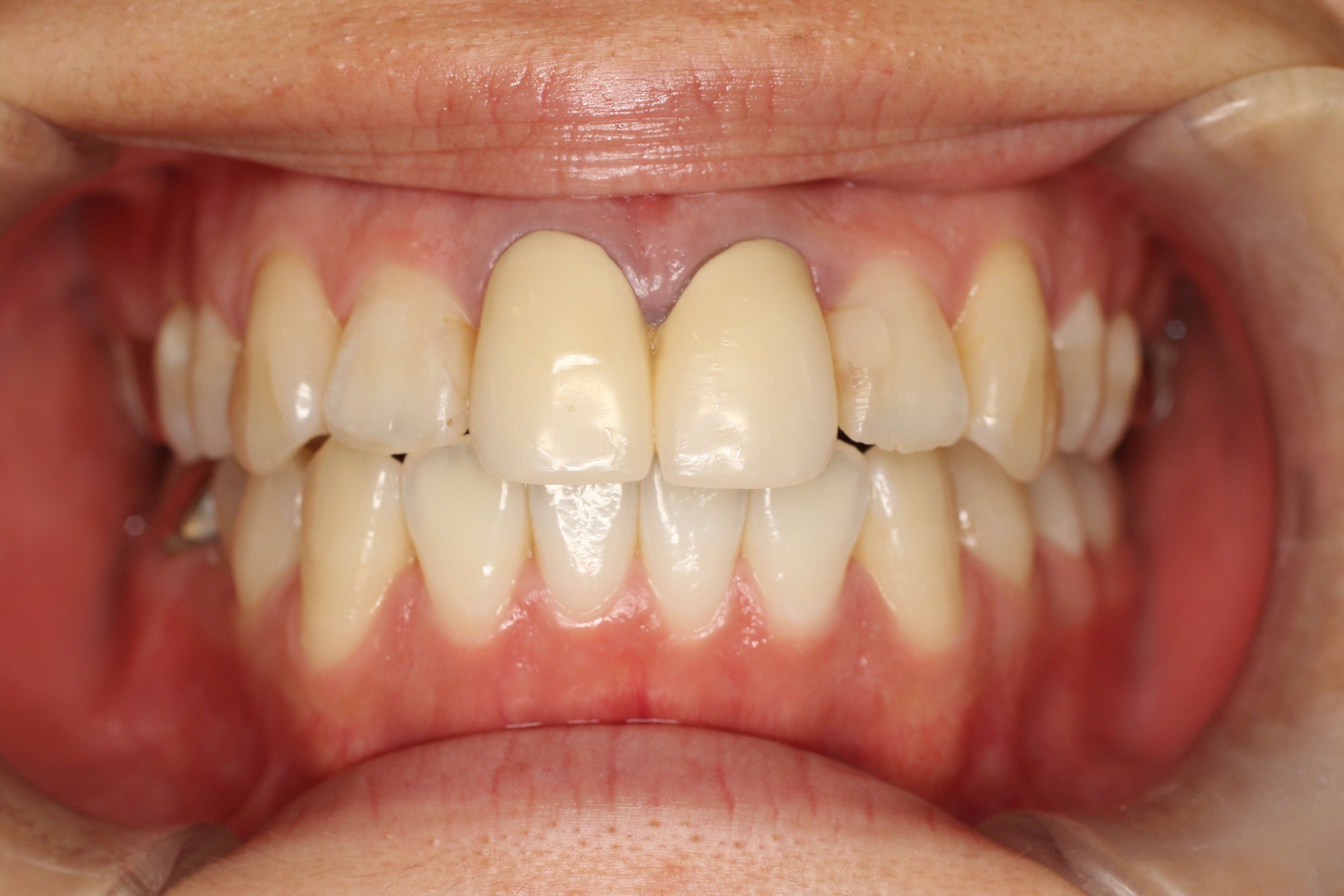 でこぼこ・リンガルの症例