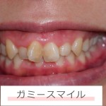 ガミースマイルは矯正で治せる？ 手術が必要なケースまでやさしく解説