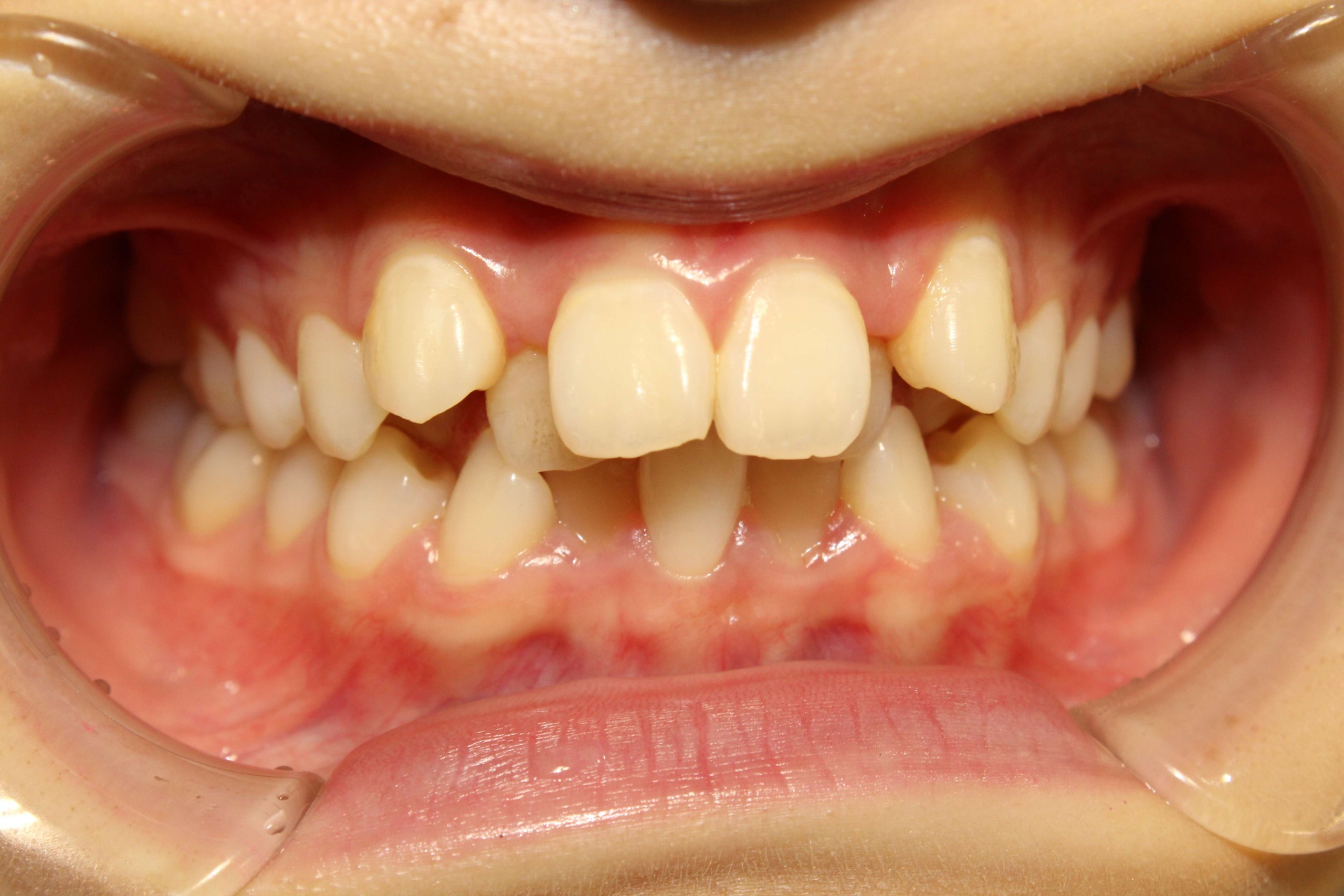 でこぼこ・噛み合わせ改善・リンガルの症例