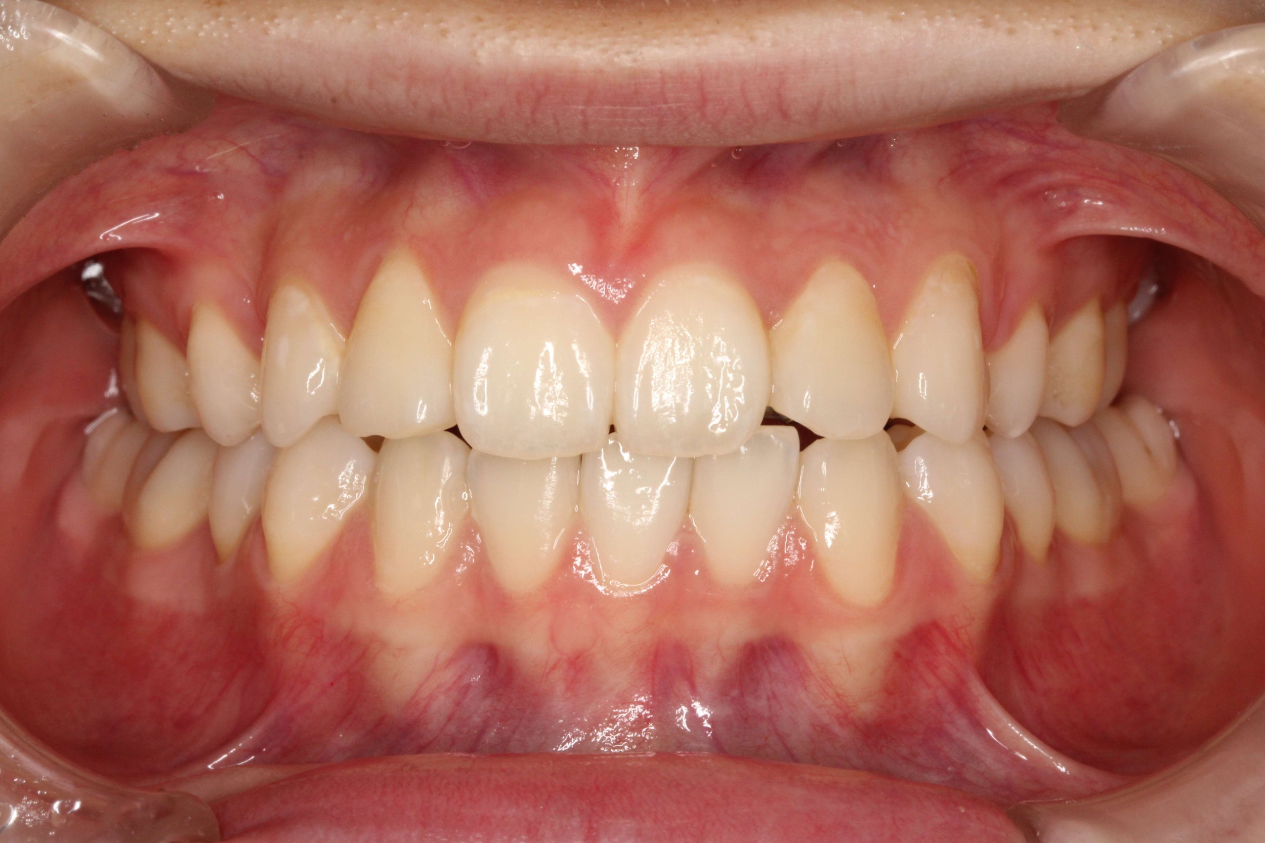 でこぼこ・噛み合わせ改善・リンガルの症例