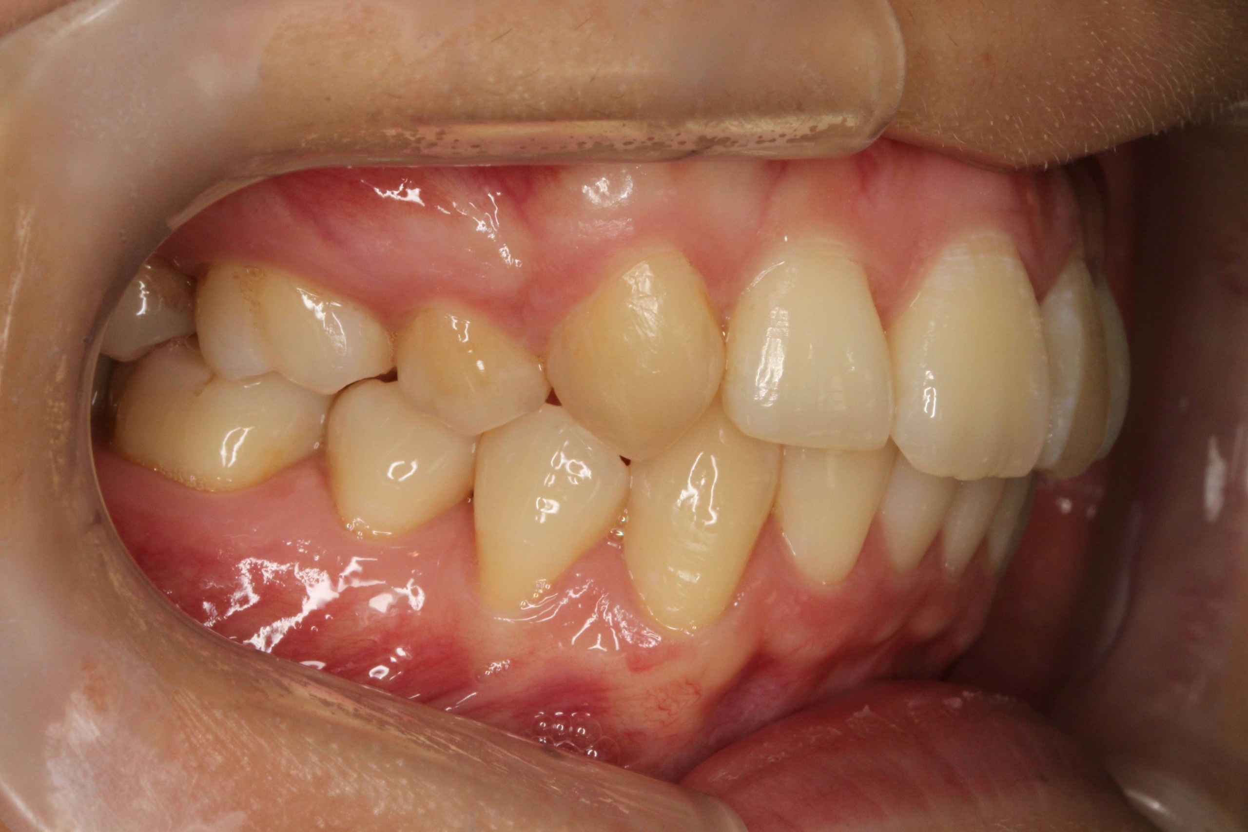 上の歯が出ている・リンガルの症例