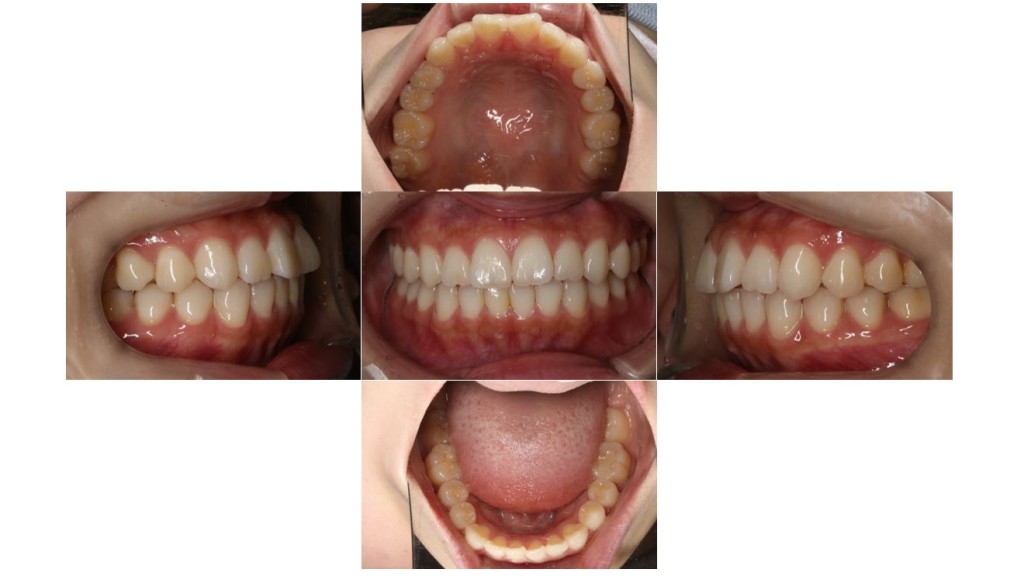 上の歯が出ている・裏側矯正の症例