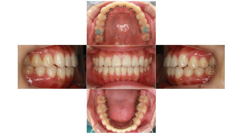 上の歯が出ている・裏側矯正の症例