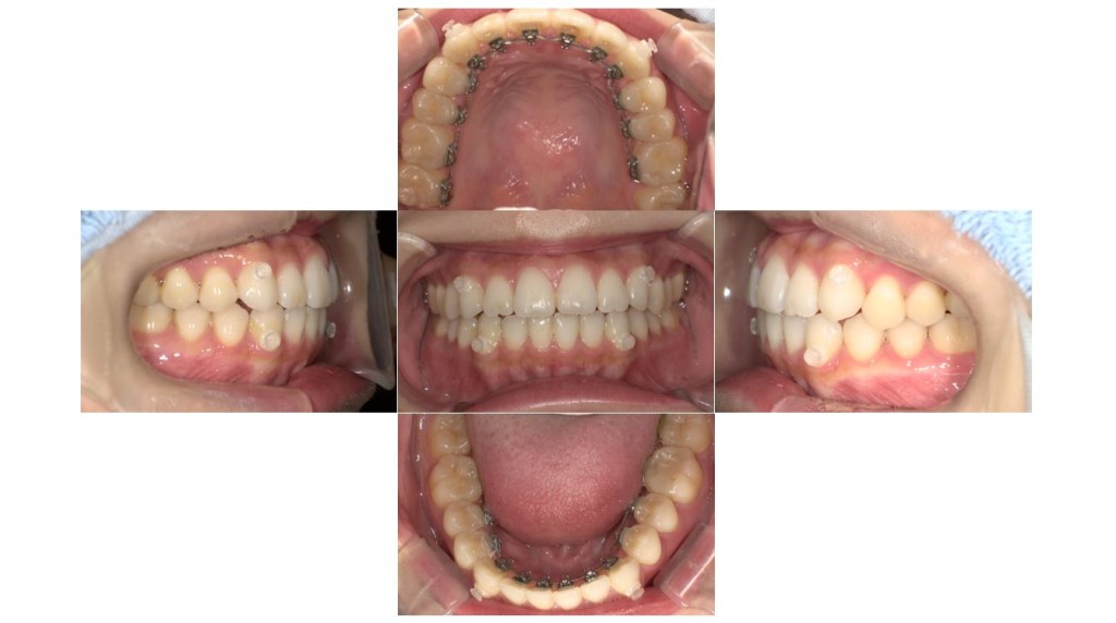 上の歯が出ている・裏側矯正の症例