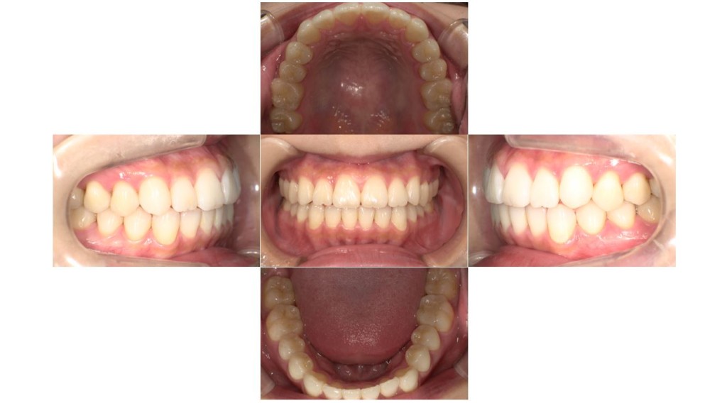上の歯が出ている・裏側矯正の症例