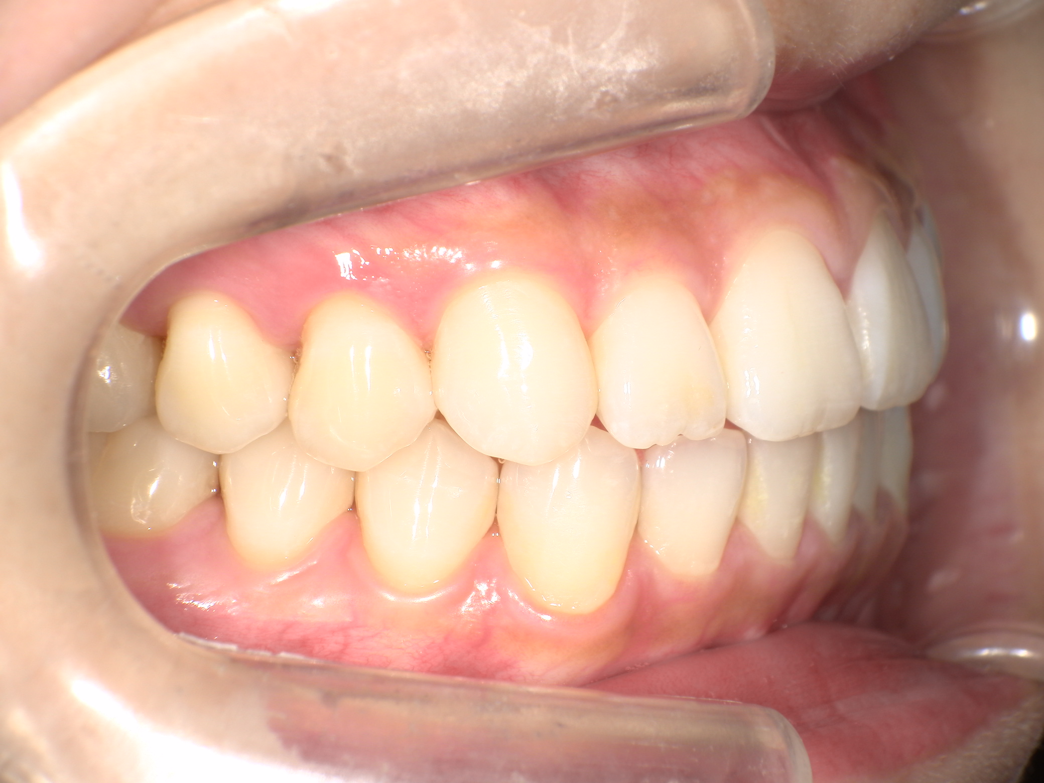 上の歯が出ている・裏側矯正の症例