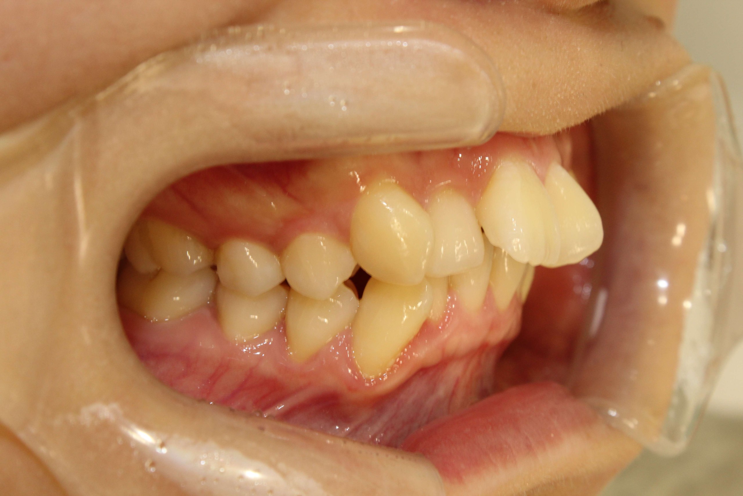 上の歯が出ている・リンガルの症例